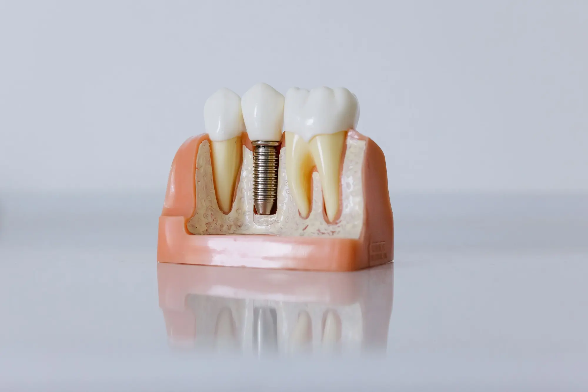 A cutaway model of dental implants and crowns on a pale surface